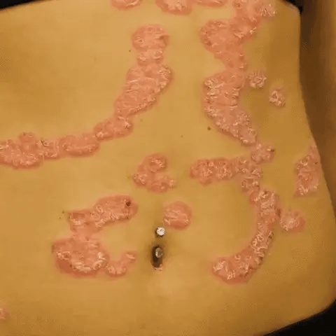 KOLMAX™ SPRAY PARA TRATAMIENTO DE PSORIASIS